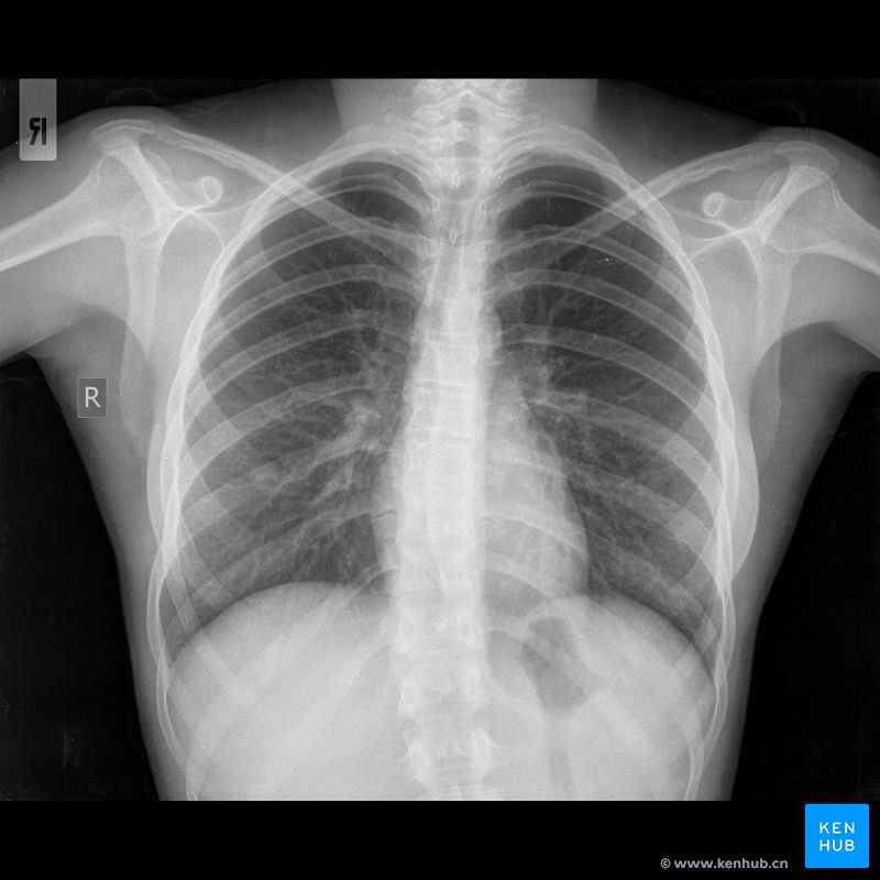 Normal chest x ray